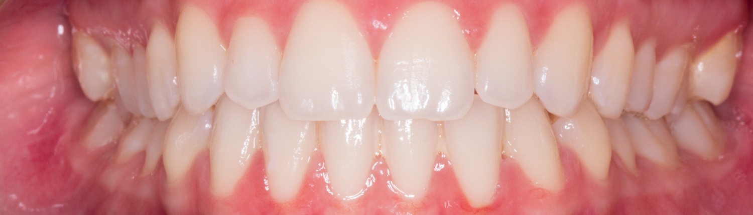 Gingivitis – So erkennt man sie und so wird sie behandelt