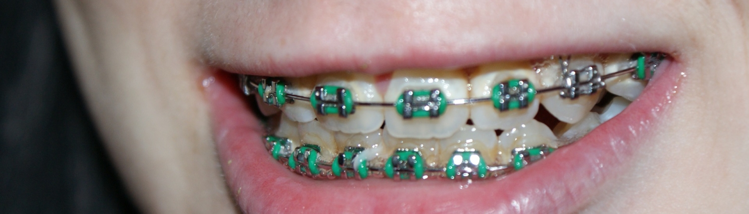 Zahnspangen im Eigenbau – ist das möglich und sinnvoll?