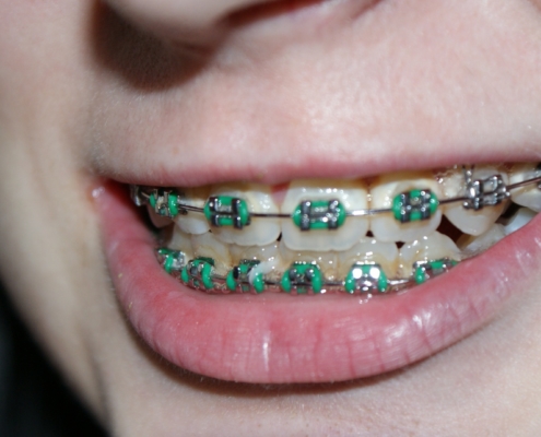 Dentalhygiene Zahnspangen im Eigenbau – ist das möglich und sinnvoll?