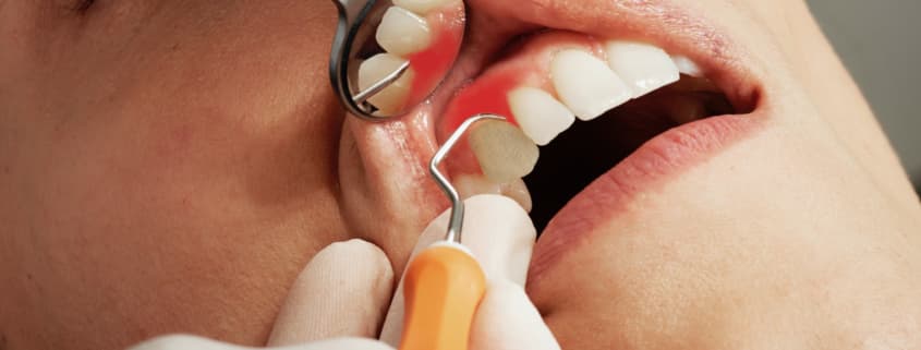 Zahnfleisch – der wirksamste Schutz für den Zahnhals