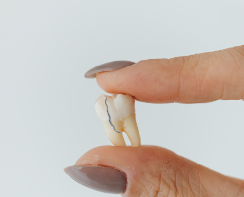 Wie behandelt der Zahnarzt eine Längsfraktur im Zahn?