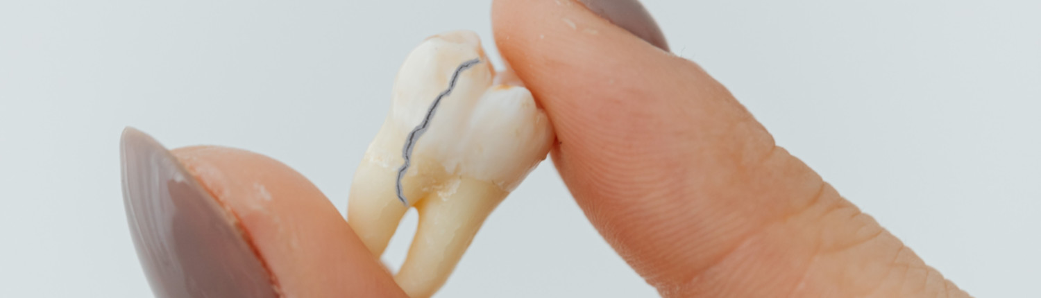 pexels-karolina-grabowska-7195433-dreh Längsfraktur im Zahn