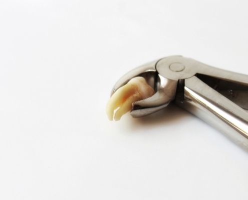 Weisheitszähne: Entfernung oder Einordnung?