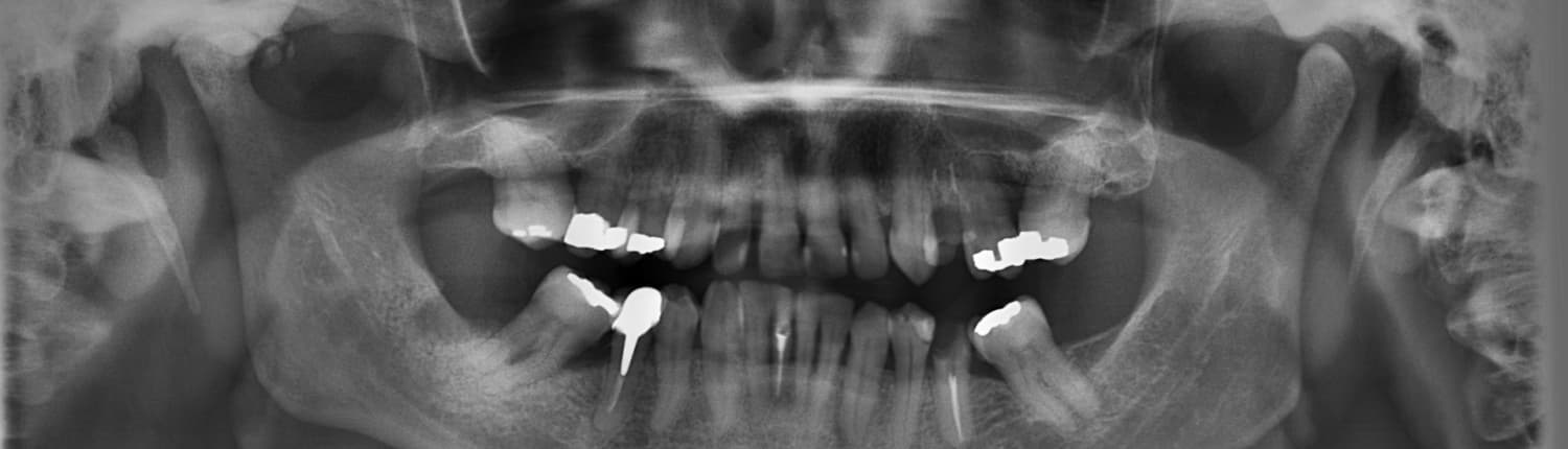 6 Schritt-Pflegeprogramm von Zahnfüllungen